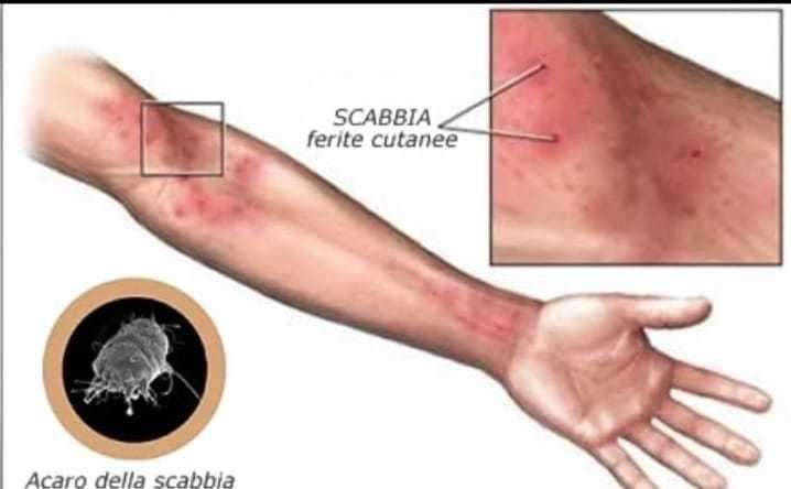 scabbia